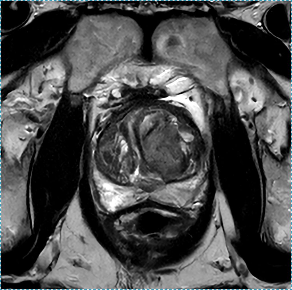 Prostate T2 TSE