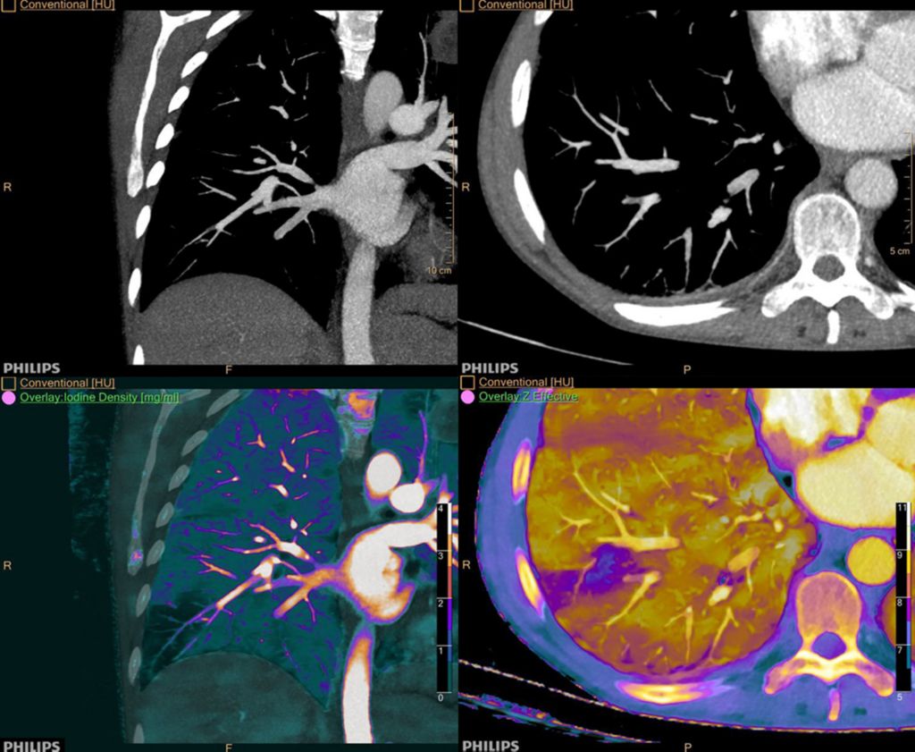 Lower Right Lung PE