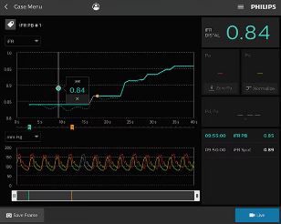 Технология обратной протяжки iFR