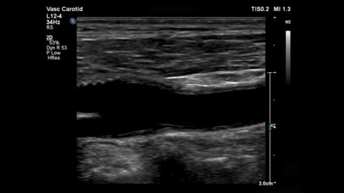 L12-4 Vascular Carotid