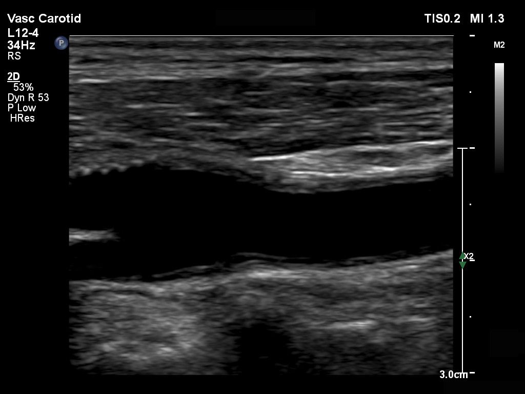 L12-4 Vascular Carotid