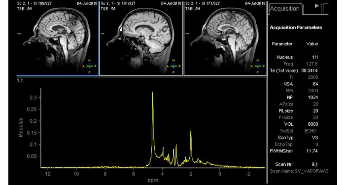 Spectroscopy XD MR Clinical application | Philips