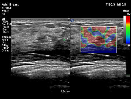 eL18-4 Linear Strain Elastography