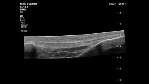 eL18-4 MSK Patella Tendon Panoramic Image