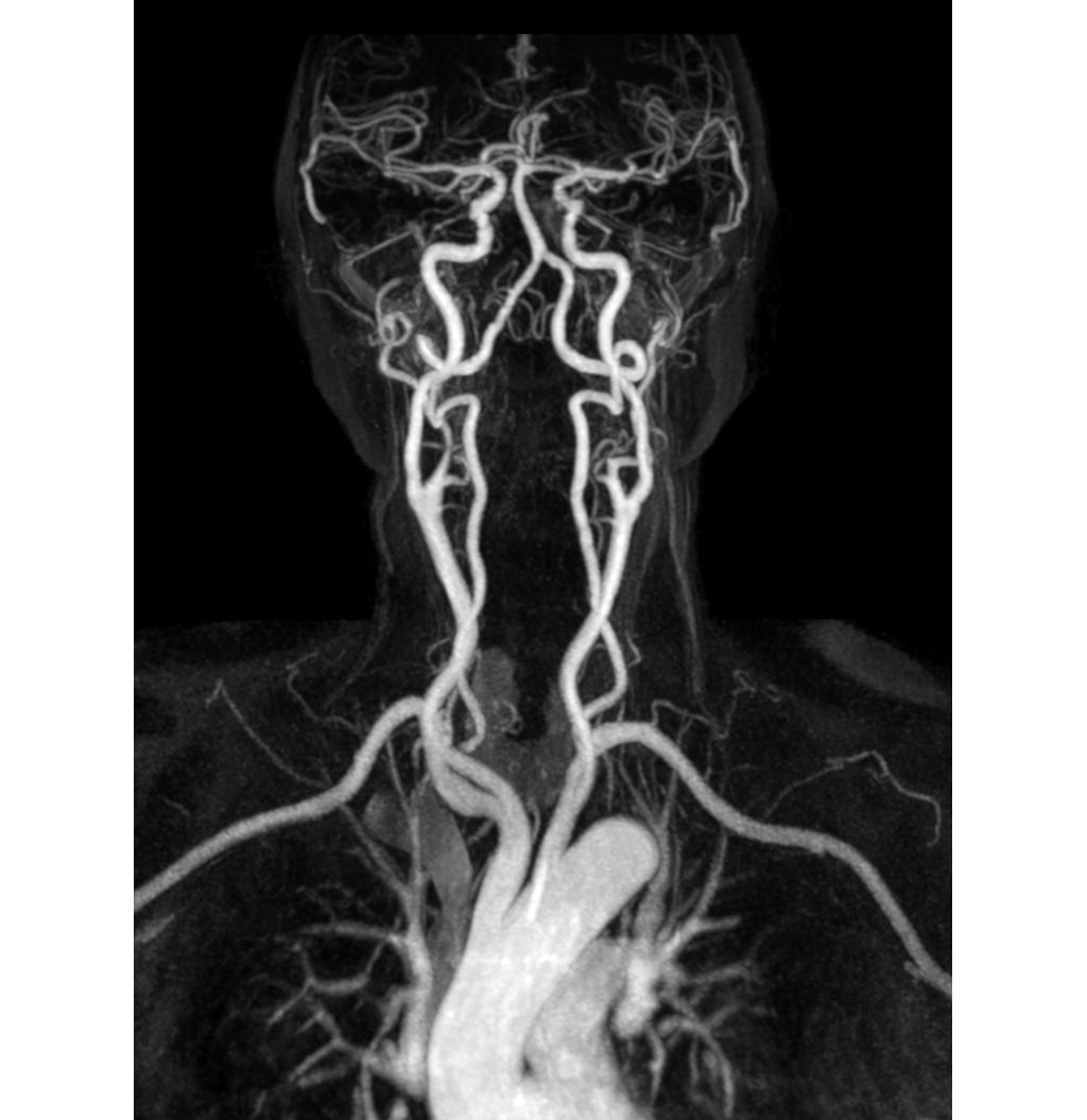 Carotid imaging