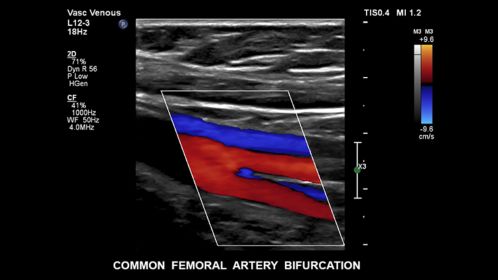 Common femoral atery bifurcation