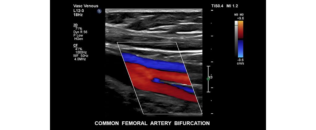 Common femoral atery bifurcation