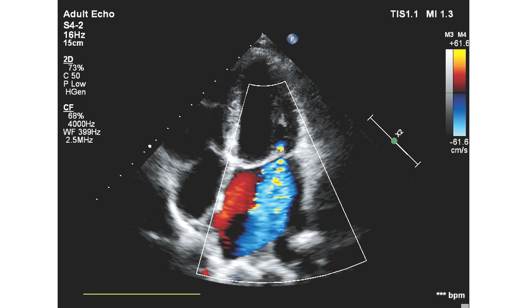 S4-2 Adult Echo