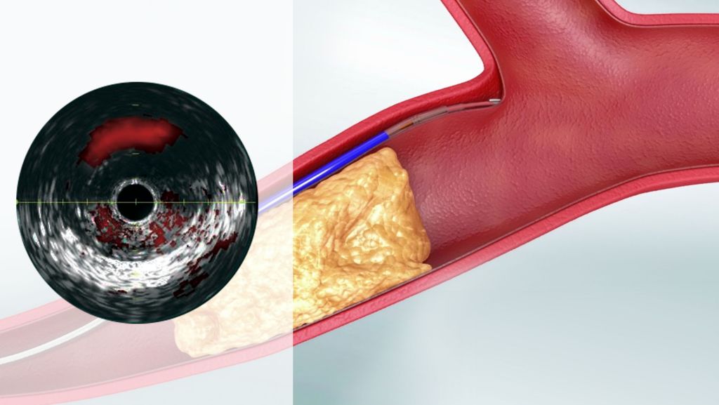 Minimize procedural complications