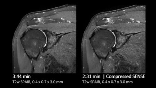Shoulder comparison Compressed SENSE
