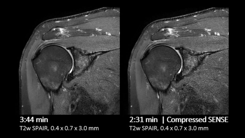 Shoulder comparison Compressed SENSE