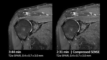 Shoulder comparison Compressed SENSE