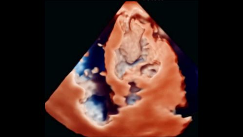 EPIQ CVx X5-1c TrueVue LV Thrombus