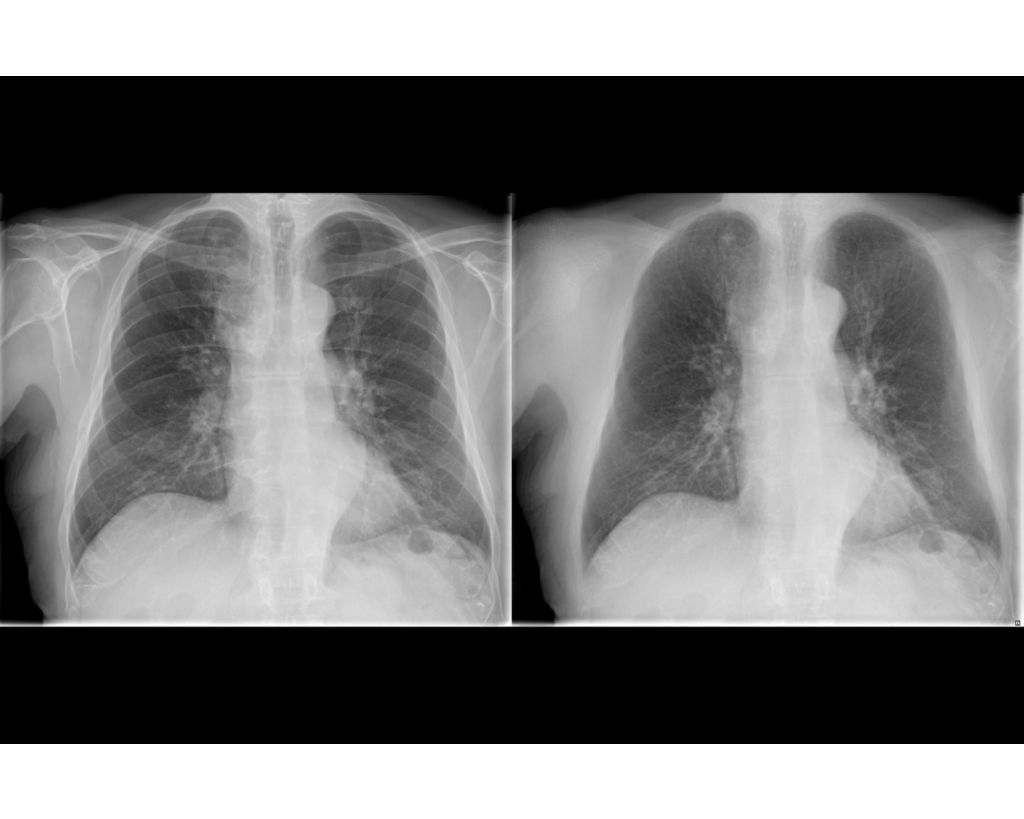 Bone Suppression Image enhancement technology