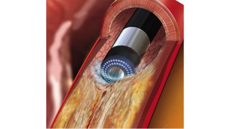 Coronary procedures