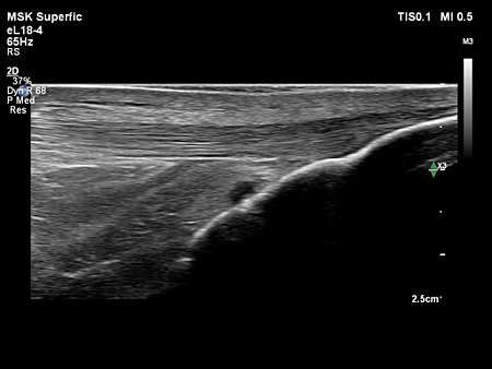eL18-4 MSK Patellar Tendon