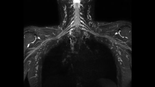 3D NerveVIEW (brachial plexus)