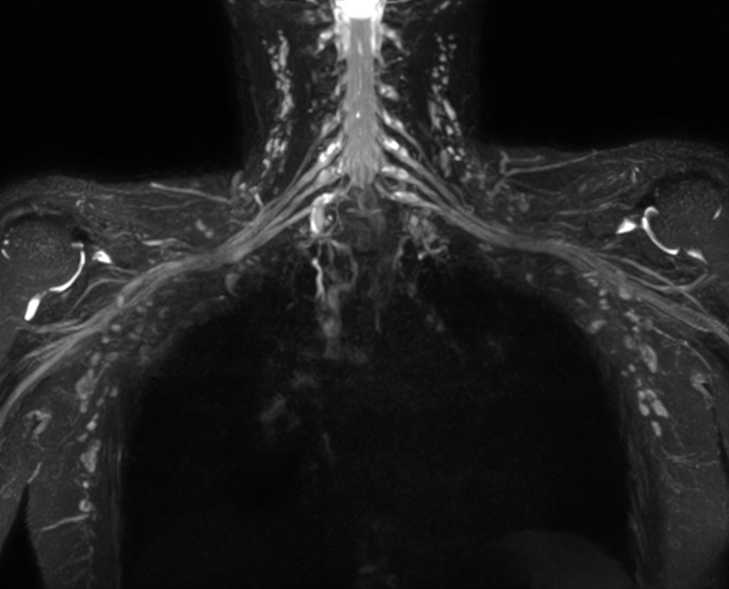 3D NerveVIEW (brachial plexus)