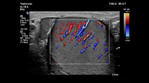 Flow Viewer applied to testicle with the eL18-4 transducer