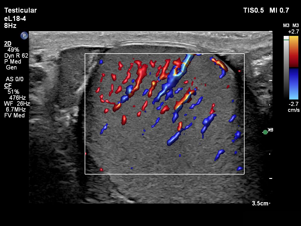 Flow Viewer applied to testicle with the eL18-4 transducer