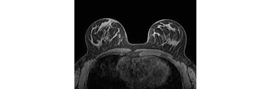 Axial eTHRIVE (FlexTrak Mammo 7ch)