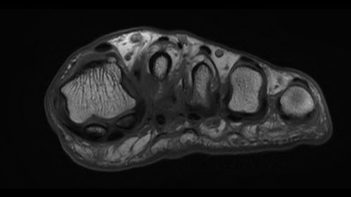 Coronal T1w Forefoot