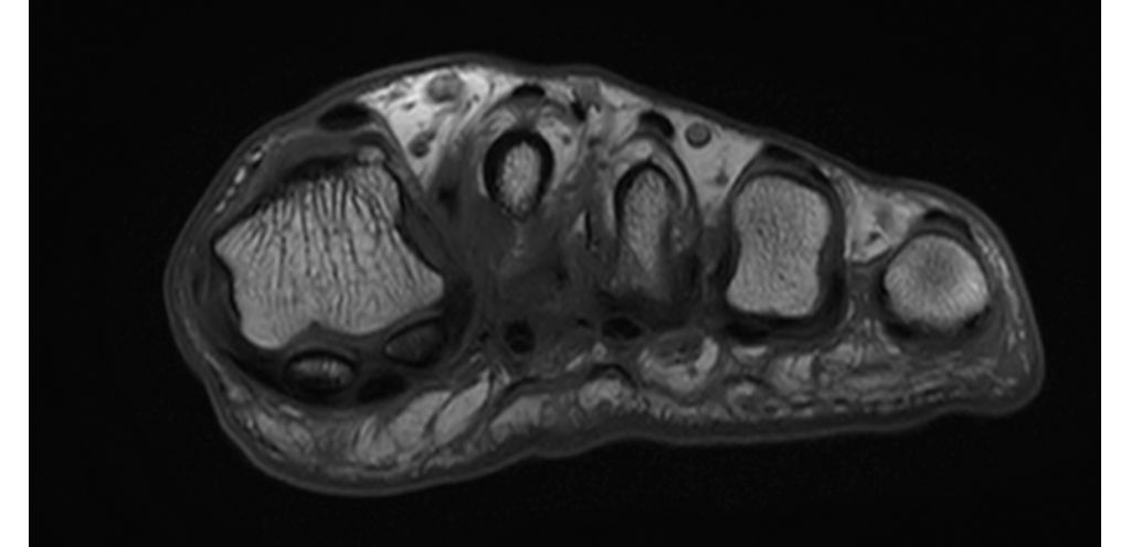 Coronal T1w Forefoot