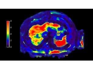 MR Elastography Extension MR clinical application