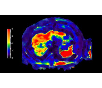 MR Elastography Extension clinical application