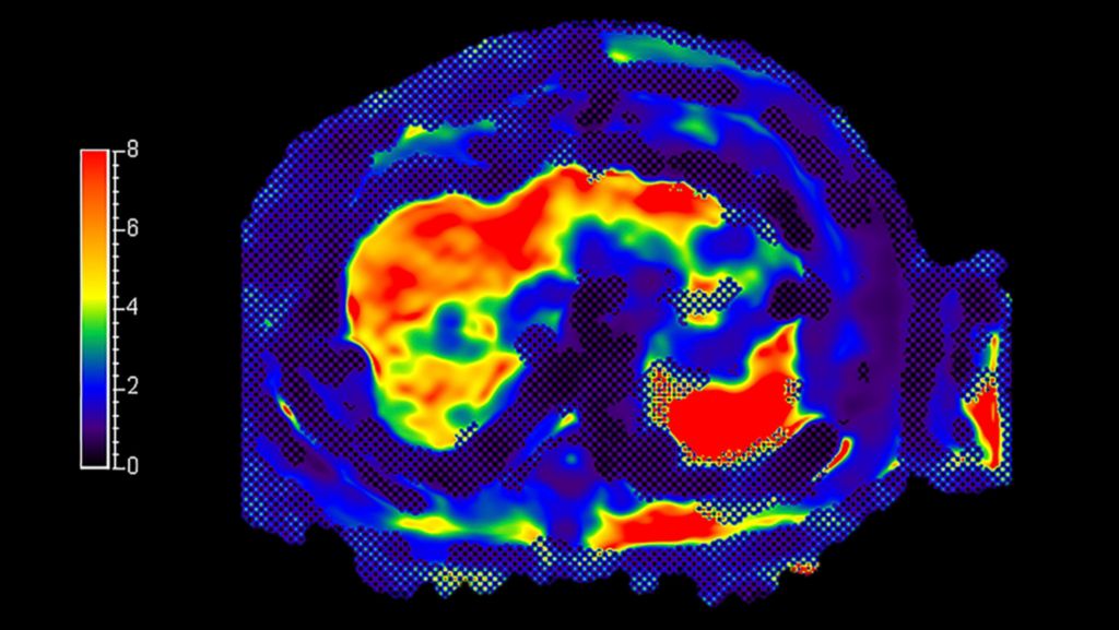 MR Elastography Extension clinical application