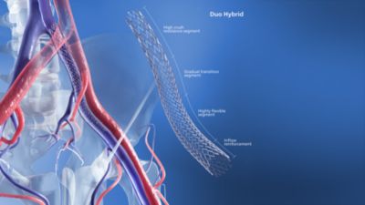 Image of Duo Hybrid stent with callouts of different features along the stent