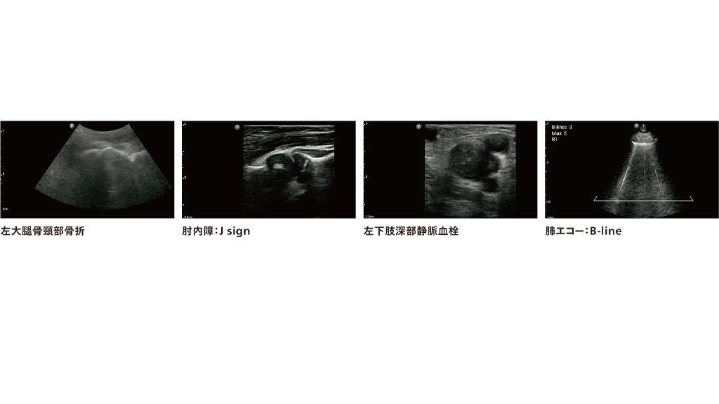 左大腿骨頸部骨折 　肘内障：J sign 　左下肢深部静脈血栓　 肺エコー：B-line