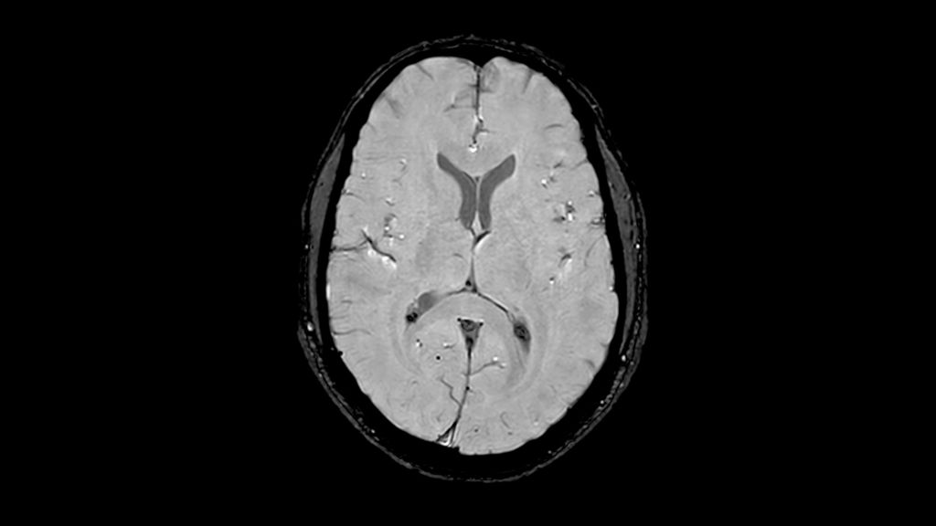 3D SWI (Magnitude) clinical image of the brain