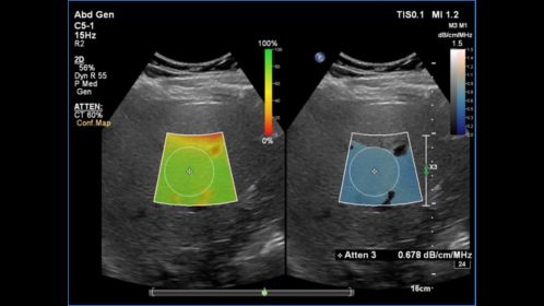 C5-1 Liver Fat Quantification
