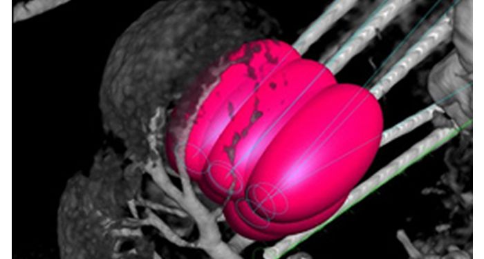 XperGuide Ablation  Программа для контроля при абляции опухолей