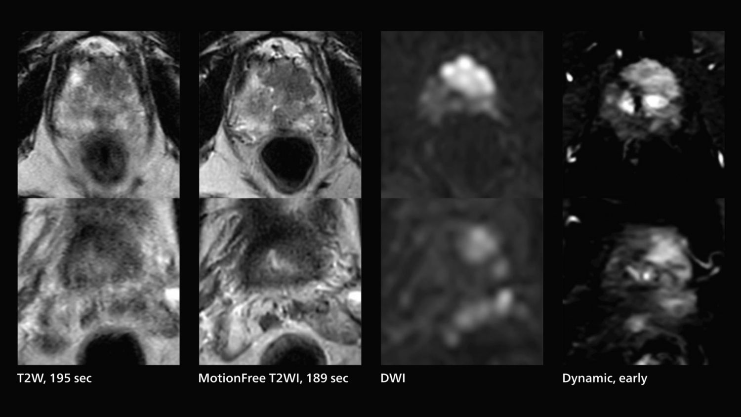AI enabled MRI exam of prostate cancer