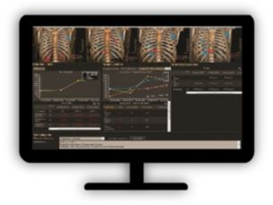 Multi Modality Tumor Tracking (MMTT) ​Streamline workflow for analysis and follow-up of oncology patients​