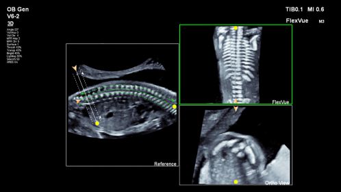Spine shown with FlexVue using V6-2 transducer