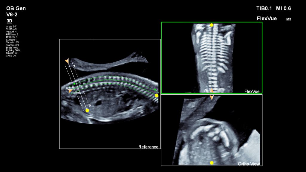 Spine shown with FlexVue using V6-2 transducer