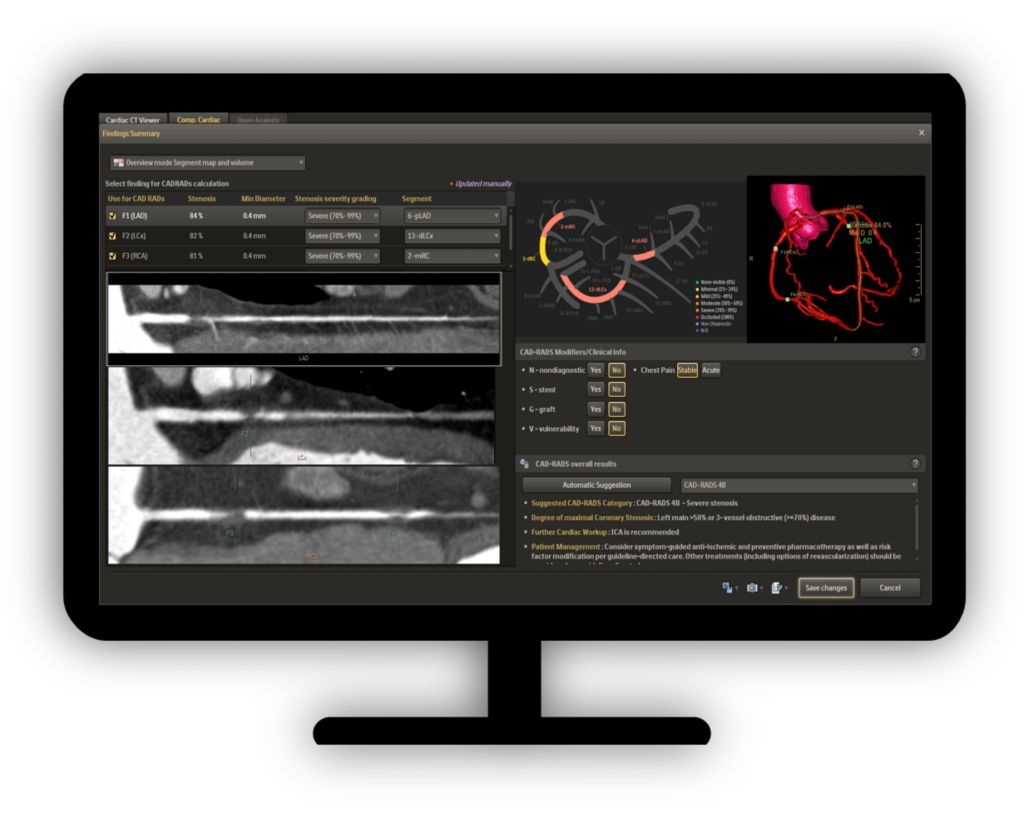 CT Comprehensive Cardiac Analysis (CCA) Comprehensive cardiac analysis supported by automatic workflow steps