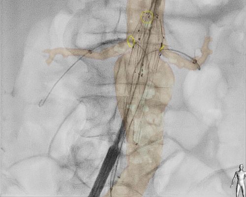 Philips VesselNavigator, a 3D roadmap overlay on a live X-ray image