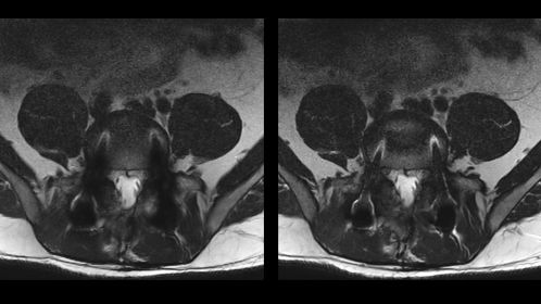 T2w TSE (left) versus O-MAR T2w (right)
