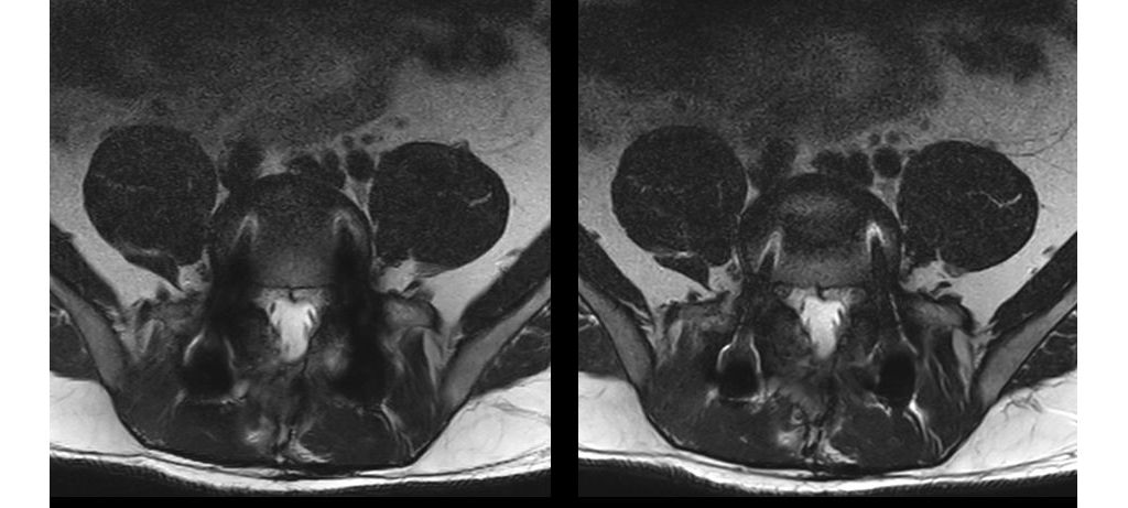 T2w TSE (left) versus O-MAR T2w (right)
