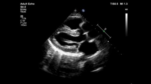 Adult echo