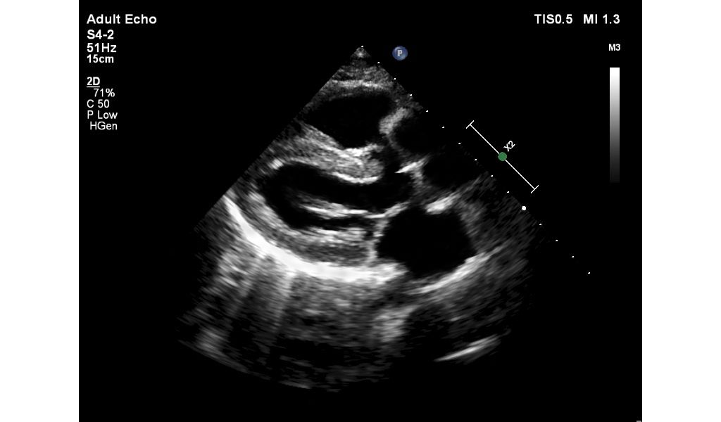 Adult echo