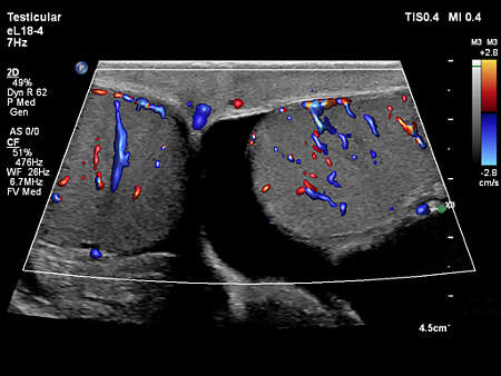eL18-4 Testicular Imaging with FlowViewer