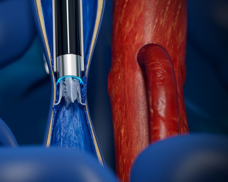 IVC filter retrieval