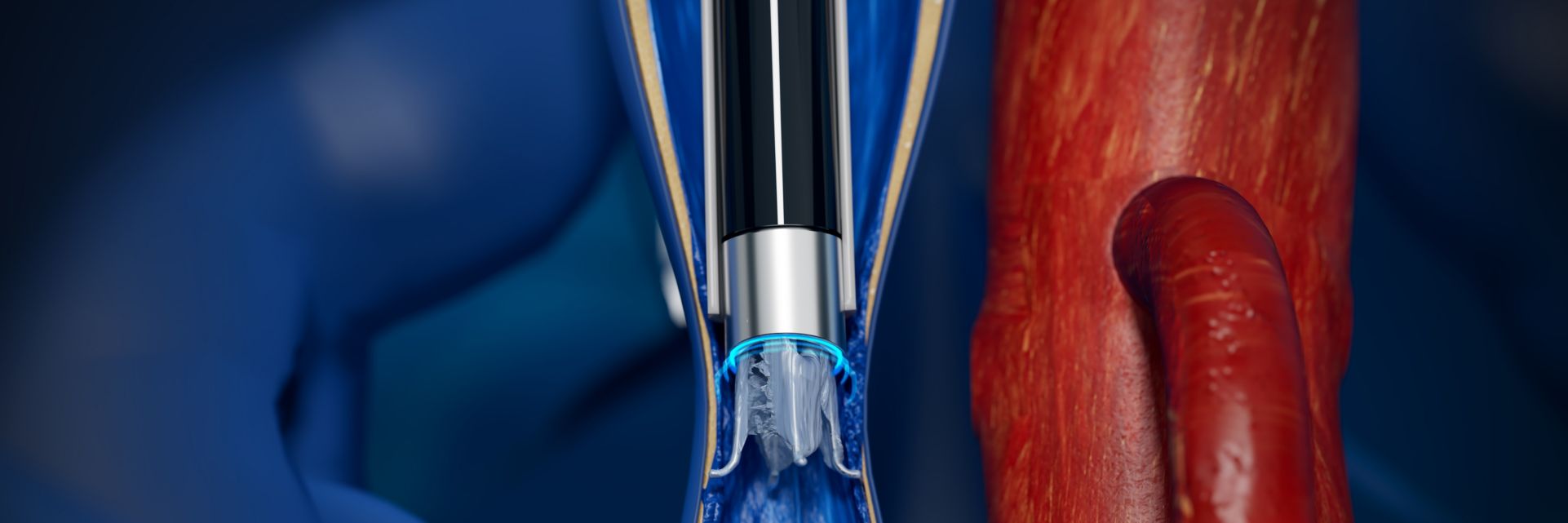 ivc filter removal