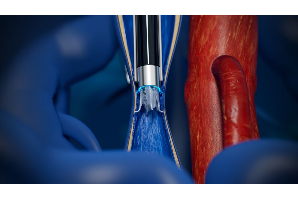 Breakthrough Device Designation is an FDA program for innovative medical devices that provides a pathway for expedited review of a more effective treatment or diagnosis of life-threatening or permanently debilitating diseases.