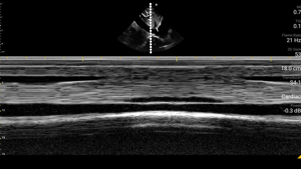 Inferior vena cava with M-Mode trace shown using S4-1 transducer. 